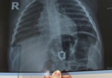Лікували застуду: на рентген-знімку в шлунку 3-річного малюка виявили 8 магнітів