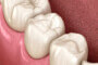Що являє собою якісна зубна реставрація?